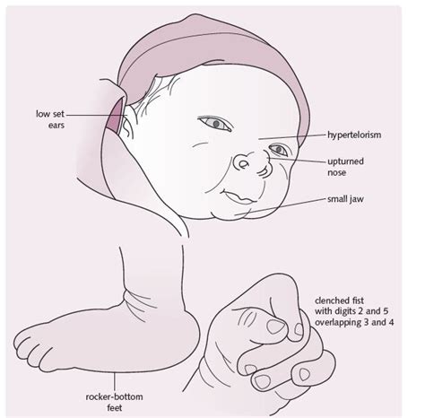 Edwards Syndrome (GDCBG).JPG (610×600) | baby items | Pinterest ...