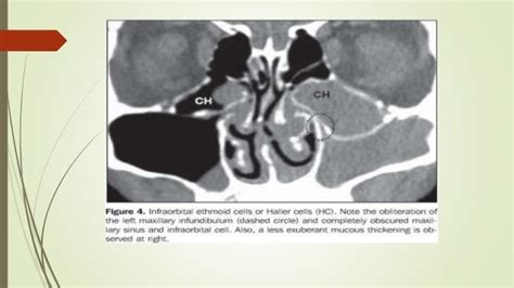 Surgical anatomy of osteomeatal complex