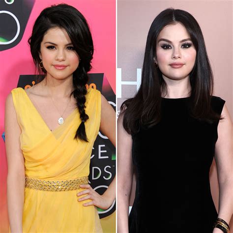 Selena Gomez Plastic Surgery Before And After