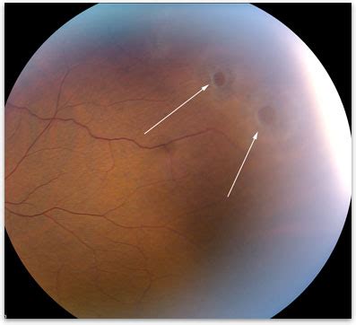 Lattice Degeneration - Retina-Vitreous Surgeons of CNY