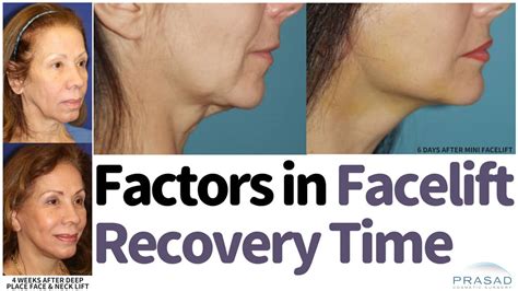 How to Speed Up Facelift Recovery | Dr. Amiya Prasad Blog | New York