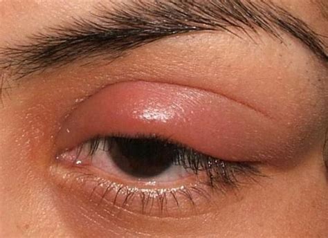 Picture of Stye / Chalazion