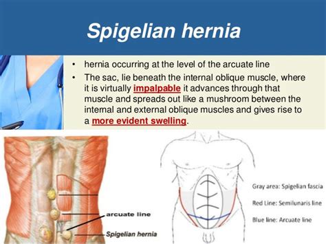 Study Medical Photos: Brief Description Of Abdominal Wall Hernias