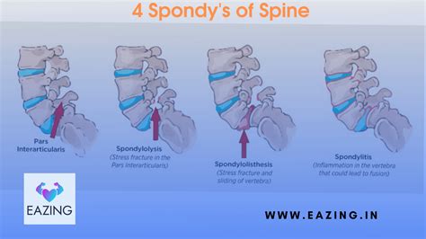 4 Spondy’s of Spine (Spondylosis, Spondylitis, Spondylolysis and ...