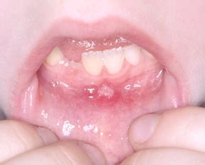 Causes Of Swollen Gum Around One Tooth And Tips For Quick Relief