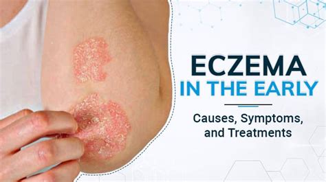 Eczema in the Early Years: Causes, Symptoms, and Treatments | Winston ...