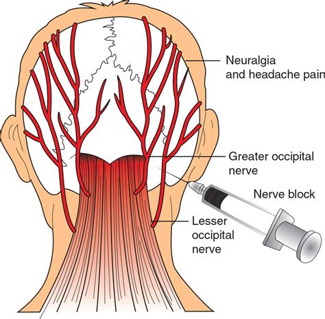 Occipital Nerve Block | Anesthesia Key