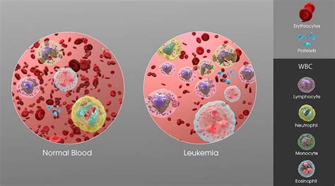 The Future of Leukemia Treatment: How Base-Edited T-Cells are Making a ...