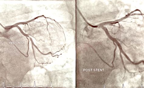 Coronary Angiography, Stents and Angioplasty - NSW Cardiology