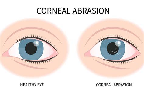 What Is Corneal Abrasion and How Can It Be Treated?