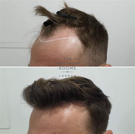 FUE Transplant Before & After | Treatment Rooms London