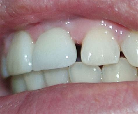 Teeth Bonding for Gaps Between Teeth - Floss & Gloss Dental - Dentist ...