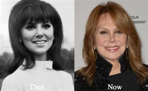 Marlo Thomas Plastic Surgery: Facelift, Eyelid Surgery, Teeth Veneer