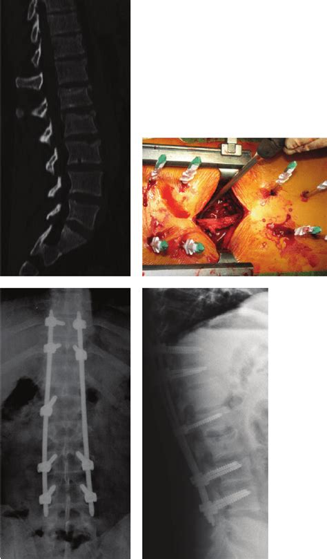 T11, T12, and L3 type A fractures associated with L1 and L2 type B ...