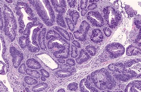 Gastric Adenocarcinoma Histology