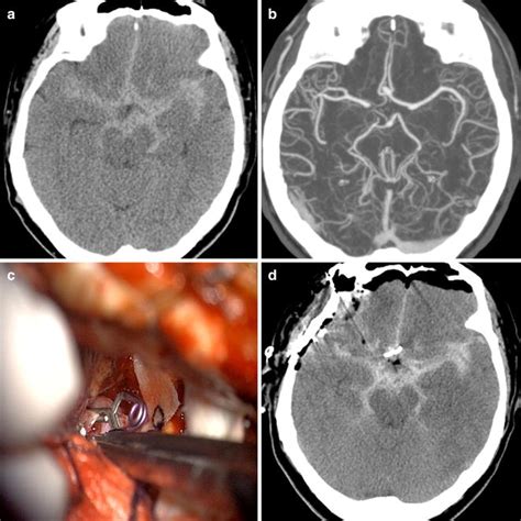 Image Result For Basal Cisterns Medical School Corpus