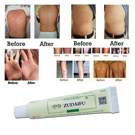 Zudaifu Skin Care Cream Skin Psoriasis Cream Dermatitis Eczematoid ...