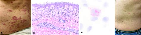 Patient 2. A, Clinical image of lichenoid dermatitis on the left side ...