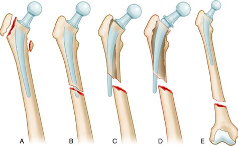 Periprosthetic Fractures around Total Hip Arthroplasty: Evaluation and ...