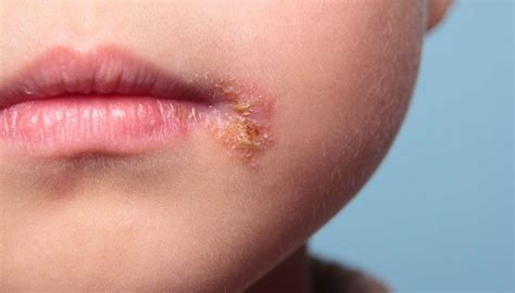 Can babies get cold sores? Causes, treatment, and risks