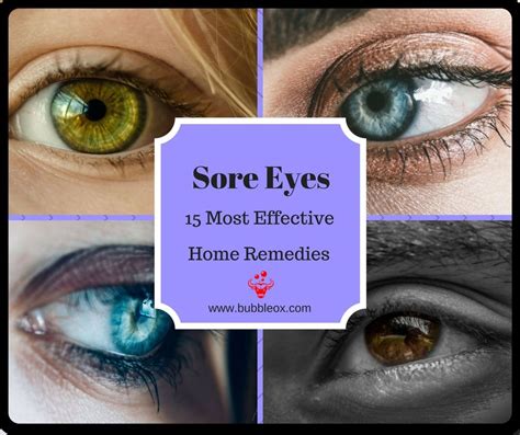 15 Most Effective Home Remedies for Sore Eyes | Sore eyes, Home ...