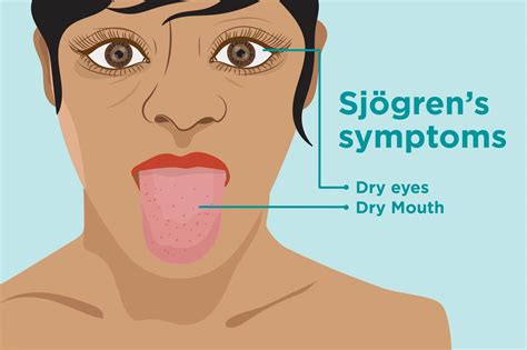 Sjögren's syndrome - Cyprus Derma Clinic