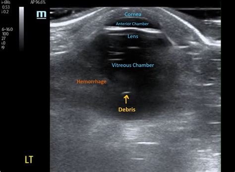 Gaining the Diagnosis of Vitreous Hemorrhage with Ultrasound