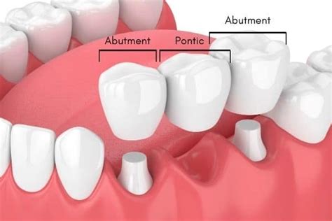 How To Care For Your Dental Bridge - Dental Studio