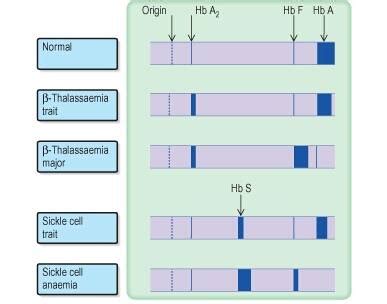 Hemoglobin electrophoresis | Medical Laboratories