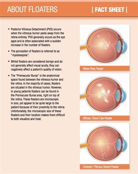 Laser Floater Treatment Chesapeake VA - Eye Floater Treatment