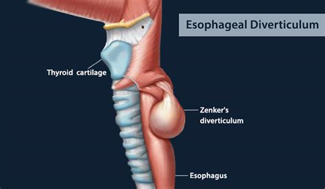 Esophageal diverticulum causes, types, symptoms, diagnosis & treatment