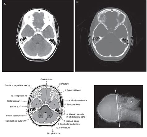 What Is A Ct Scan Of The Brain