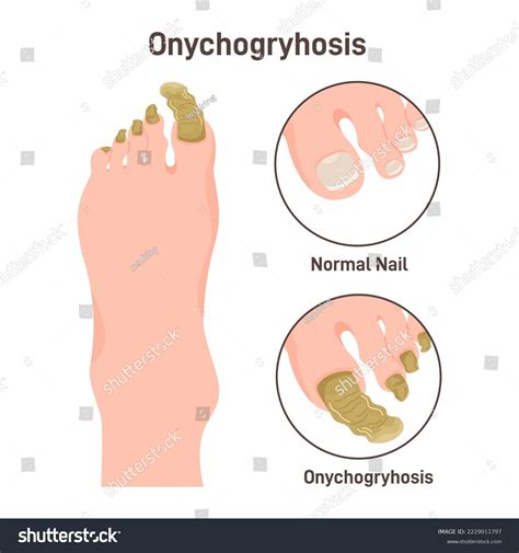 Boyner Clinic What Is The Onychogryphosis Onychogryphosis,, 54% OFF