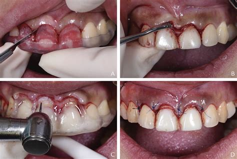 A digitally guided dual technique for both gingival and bone resection ...