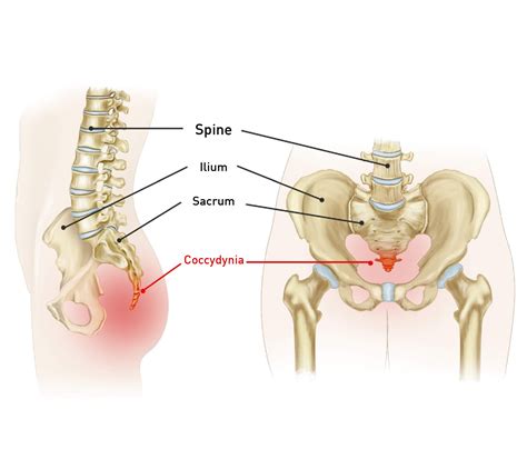 Coccyx Pain Causes