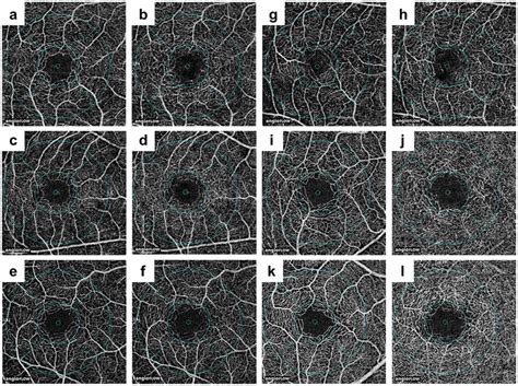 Representative optical coherence tomography images of the parafoveal ...