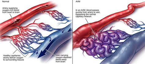 Arteriovenous Malformation - Brain Avm - Causes, Symptoms, Treatment