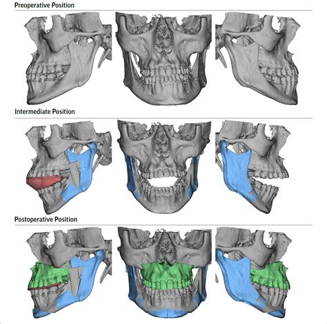 Jaw Expander for Adults - Modern Orthodontic Clinic in Sammamish & Bellevue