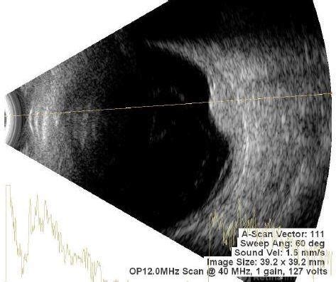 Choroidal Hemangioma - Retina Image Bank