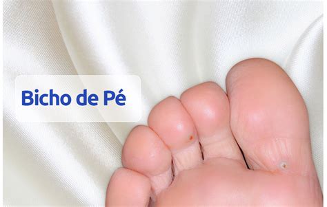 Será que é bicho de pé? Doctor Feet Podologia