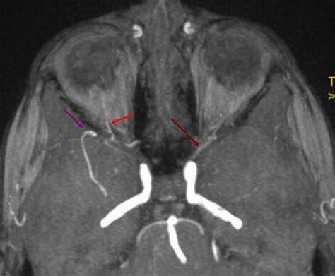 Middle Meningeal Artery | neuroangio.org