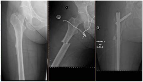 Atypical femur fractures: current understanding and approach to ...