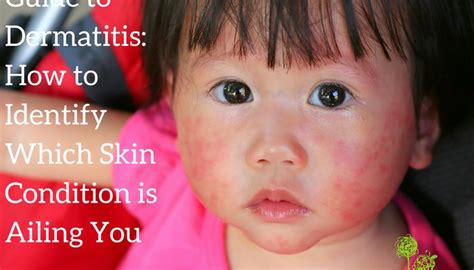 Types of Dermatitis: How to Identify which One You Have Atopic ...