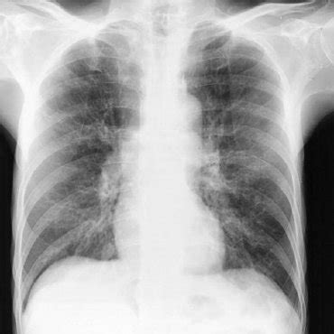 Purpuric and petechial rash involving the periumbilical area, abdomen ...