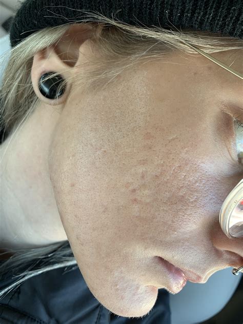 [skin concerns] does this look like a damaged moisture barrier? it ...