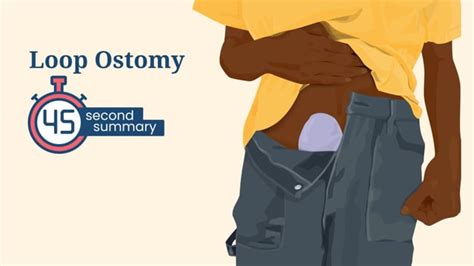 What's a Loop Ostomy? (Video) – Kidshealth | Akron Children's