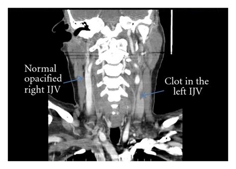 CT scan of the head and neck with contrast demonstrated a thrombus in ...