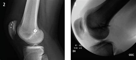 Medial Patella Femoral Ligament (MPFL) Reconstruction for ...