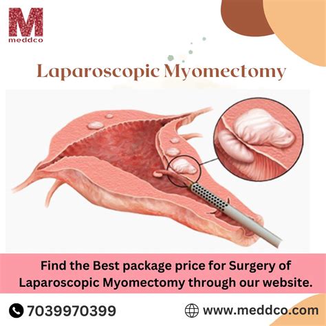 Laparoscopic Myomectomy - An Overview