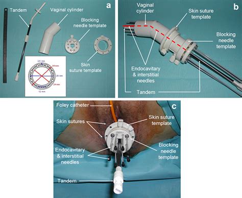 Interstitial preoperative high-dose-rate brachytherapy for early stage ...